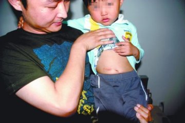 5岁儿童吃了“来一口”果冻：开肚取出一团胶