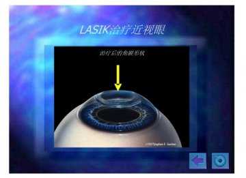 lasik18