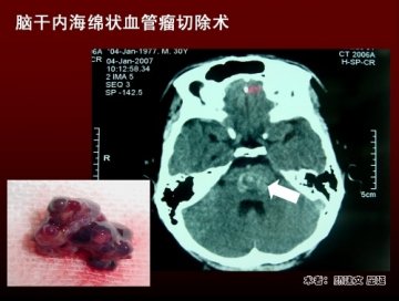 脑干肿瘤术后第四天基本脱离危险