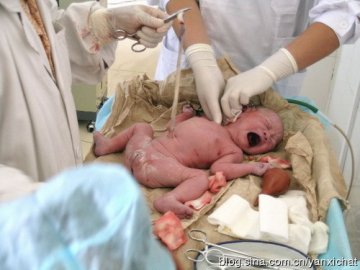 女性很伟大！惊心动魄剖腹产全程
