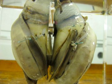 全球首例未成年人植入永久性人造心脏手术成功