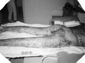 烧伤皮肤原位再生医疗技术成功救治大面积烧伤患者
