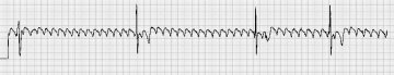 心房扑动Atrial Flutter