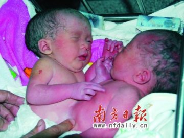 孕妇剖腹产下女婴肝脏连在一起