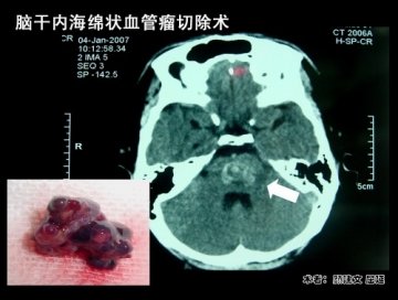 脑干肿瘤