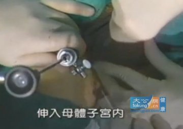 实拍堕胎手术全过程 呼吁珍惜生命