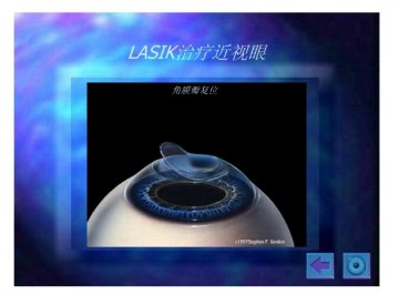 lasik17