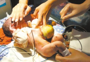 出生9天男婴先天发育不全 腹壁薄如纸脏器皆可见