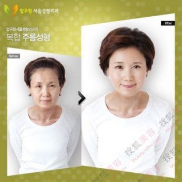 31个惊人韩国整容案例