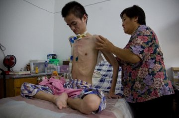 庞贝氏病患者带着呼吸机的生活