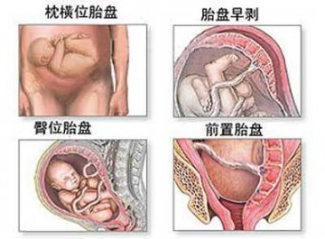 女性剖腹产手术全过程图解