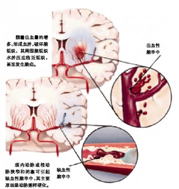 脑卒中：重视早期轻微症状