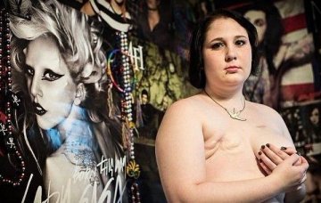 因乳腺癌切除胸部的女人