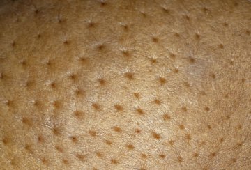 炎性乳腺癌症状