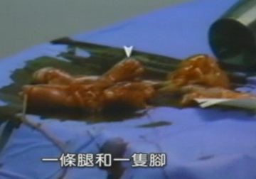 实拍少女人流全过程
