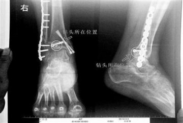 术后钻头被遗留在患者腿里 北京丰台区右安门医院称危害不大