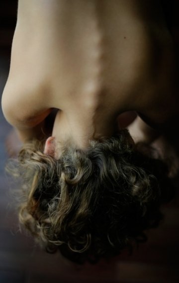 与脊柱矫正器相伴的少女青春时光