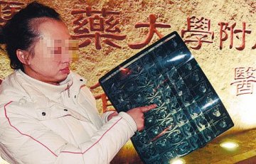 产妇剖腹产胎盘未取净 生产两月再次被剖宫