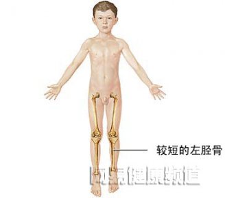 腿延长术