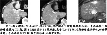 肝癌影像分期关注七项指标
