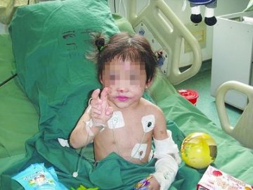 6岁女孩不肯叫妈遭到生母暴打 7根肋骨骨折