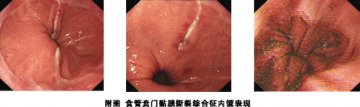 食管贲门黏膜撕裂综合征，认清几大“最”