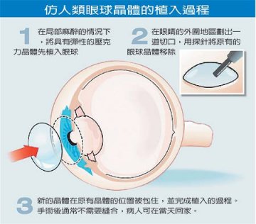英国研发超级晶体解决近视及白内障问题