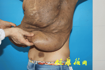 一病一治：背部“胎记”原是重达40余斤的纤维瘤