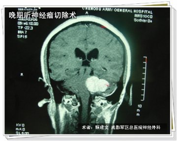 晚期听神经瘤手术
