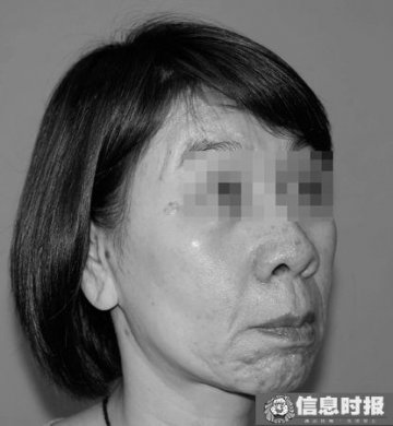 28岁女孩患上衰老症面容如60岁