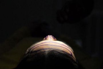 京城变性人手术全过程