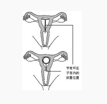 女性上避孕环全过程