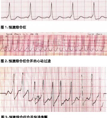 预激综合征