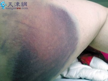 血友病救命药全国断货 患者苦撑20多天出血不止