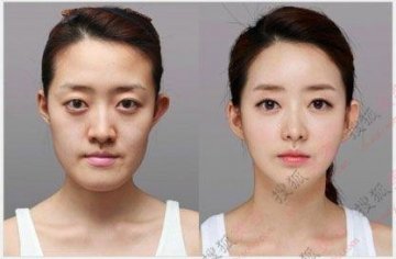 31个惊人韩国整容案例