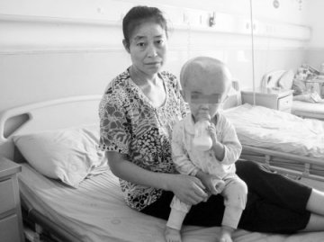 “大头娃娃”脑外积水 头围65厘米大脑萎缩