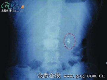 女子喝水吞下两颗钉 通过开腹手术取出