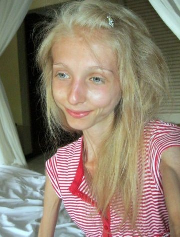 俄减肥达人仅20kg