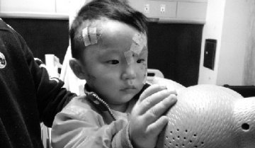19月大幼儿被恶犬咬至毁容续：面部伤口愈合良好