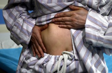女子隆胸后假体破裂 凝胶材料满身跑