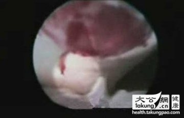 神奇的生命：实拍女性排卵真实过程
