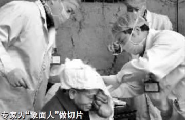 罕见“象面人”引关注 专家会诊拟为其变脸