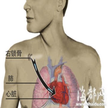 男子锁骨骨折固定钢钉游入心脏 医生称是谜