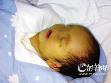 无鼻宝宝遭父母遗弃医院