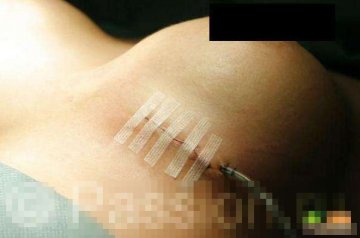 实拍国外隆胸手术全程