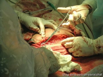 女性很伟大！惊心动魄剖腹产全程