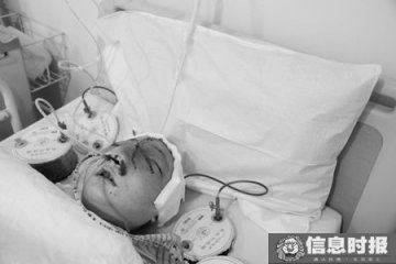 女孩五官严重畸形接受手术治疗