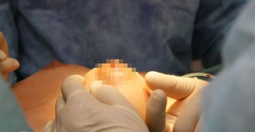 实拍国外隆胸手术全过程