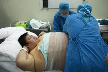 西北第一胖抽脂减肥