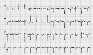 一度房室传导阻滞 first degree heart block